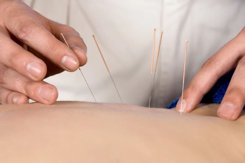 Acupuncture on the back